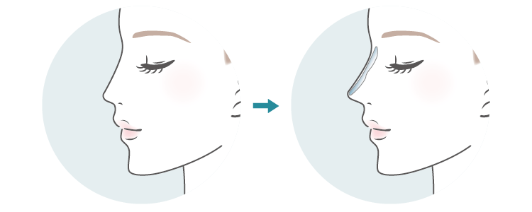 プロテーゼ挿入イメージ