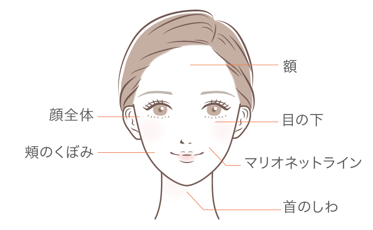 コラージュ注入部位