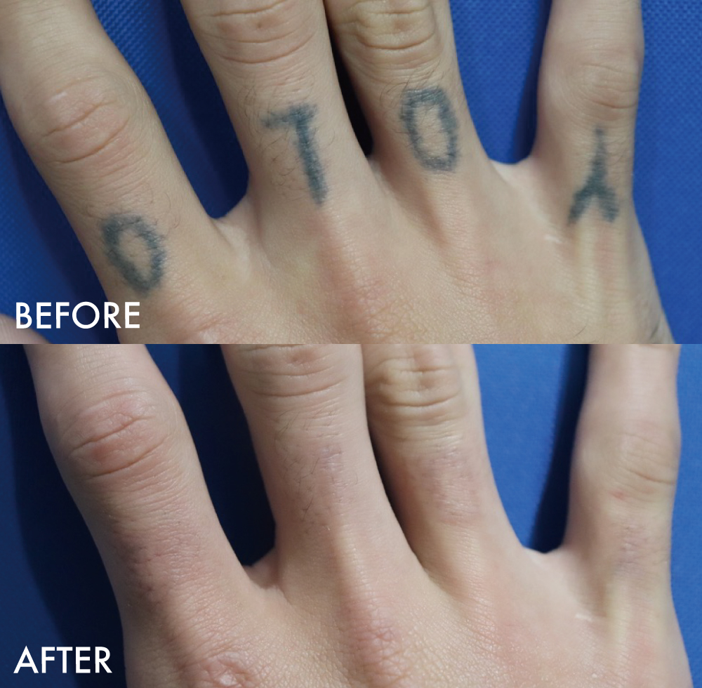 タトゥー症例指