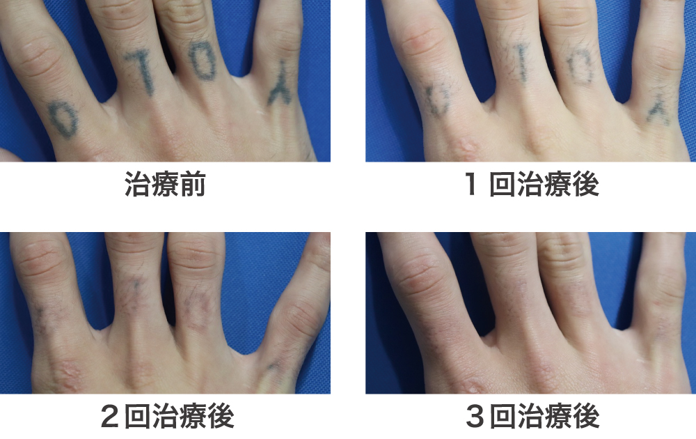 タトゥー症例指治療経過