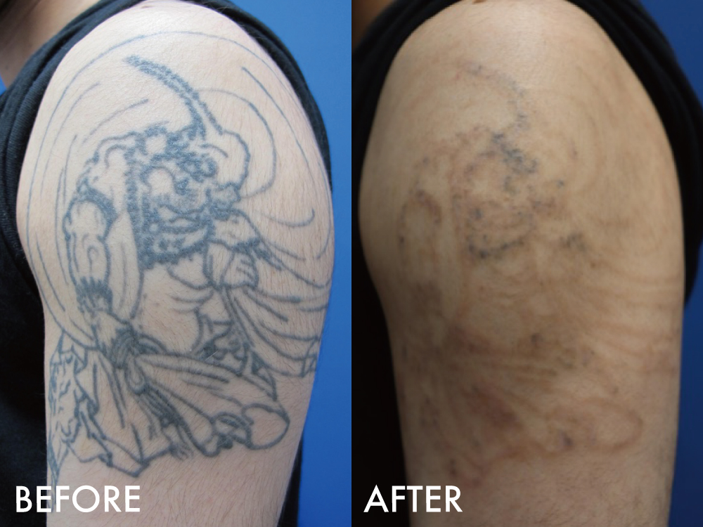 タトゥー症例腕