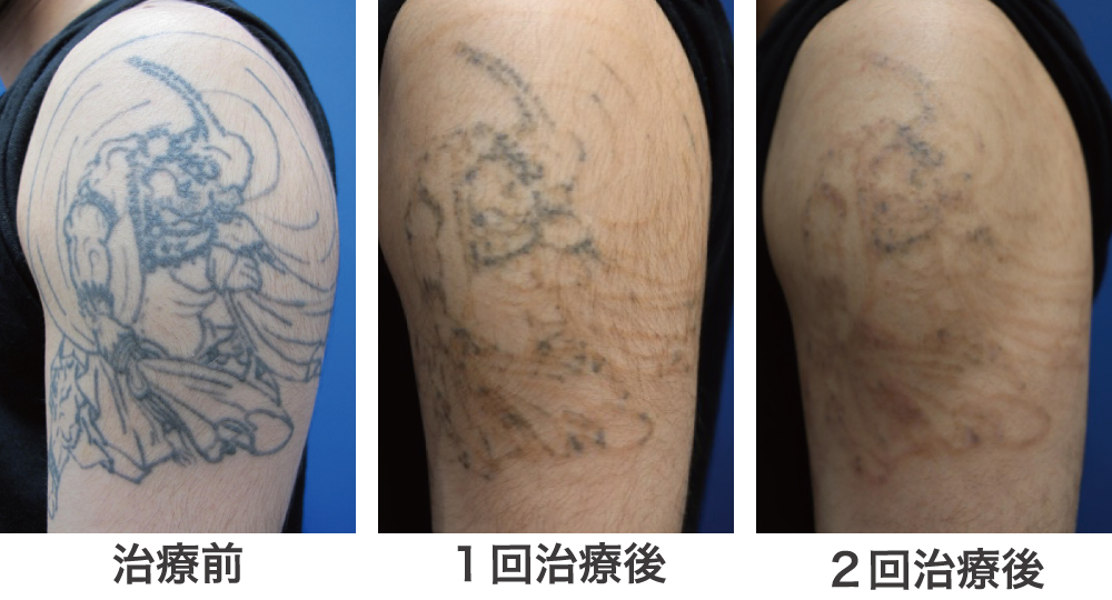 タトゥー症例腕治療経過