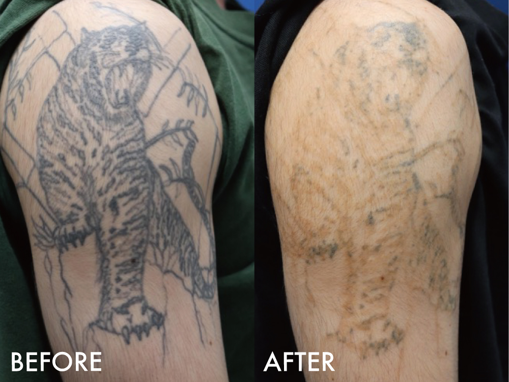 タトゥー症例腕