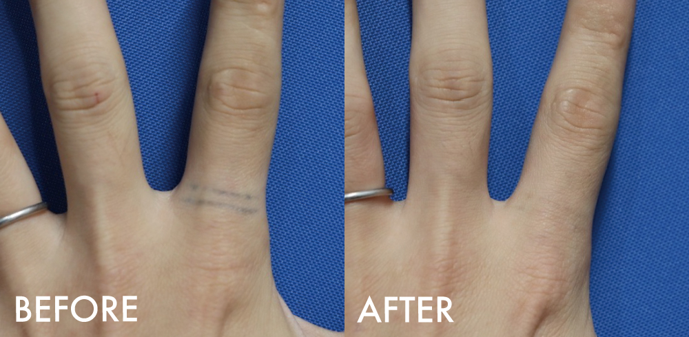 タトゥー症例指