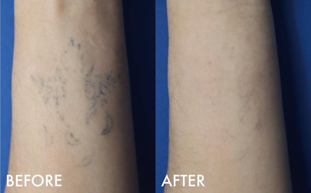 タトゥー症例指